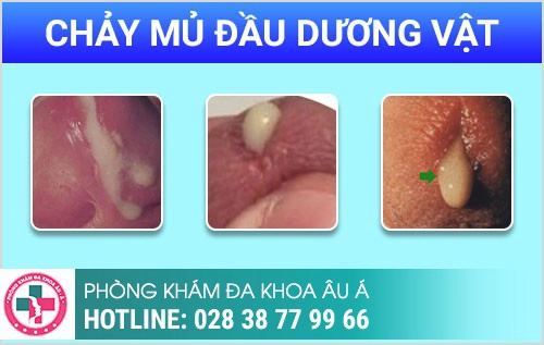 Dương vật nặng mùi