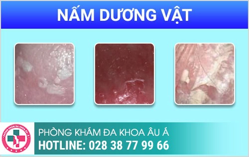 Dương vật nặng mùi