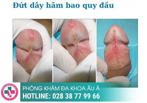 Hiện tượng bị đứt dây hãm bao quy đầu