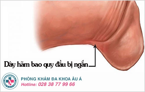 đứt dây hãm bao quy đầu