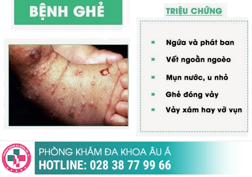 Dấu hiệu bệnh ghẻ ở bộ phận sinh dục nam