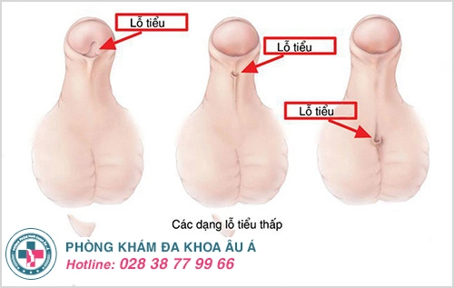 Thông tin xung quanh vấn đề hẹp lỗ tiểu