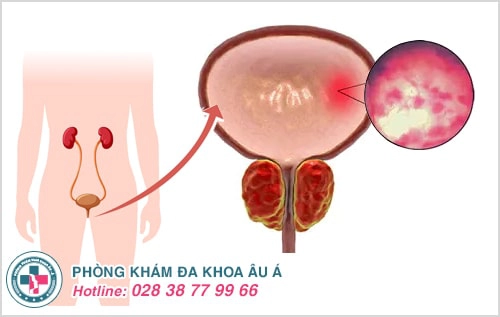 Nguyên nhân và dấu hiệu viêm bàng quang nam, nữ