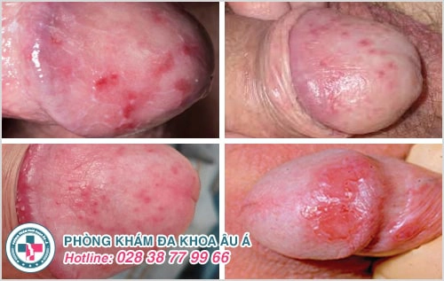6 bệnh viêm nhiễm cơ quan sinh dục nam không nên bỏ qua