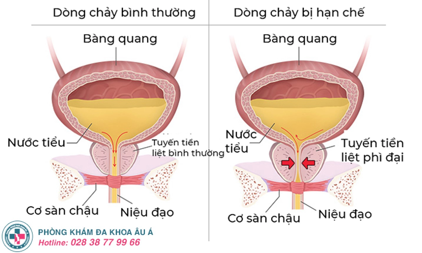 Tiểu không hết