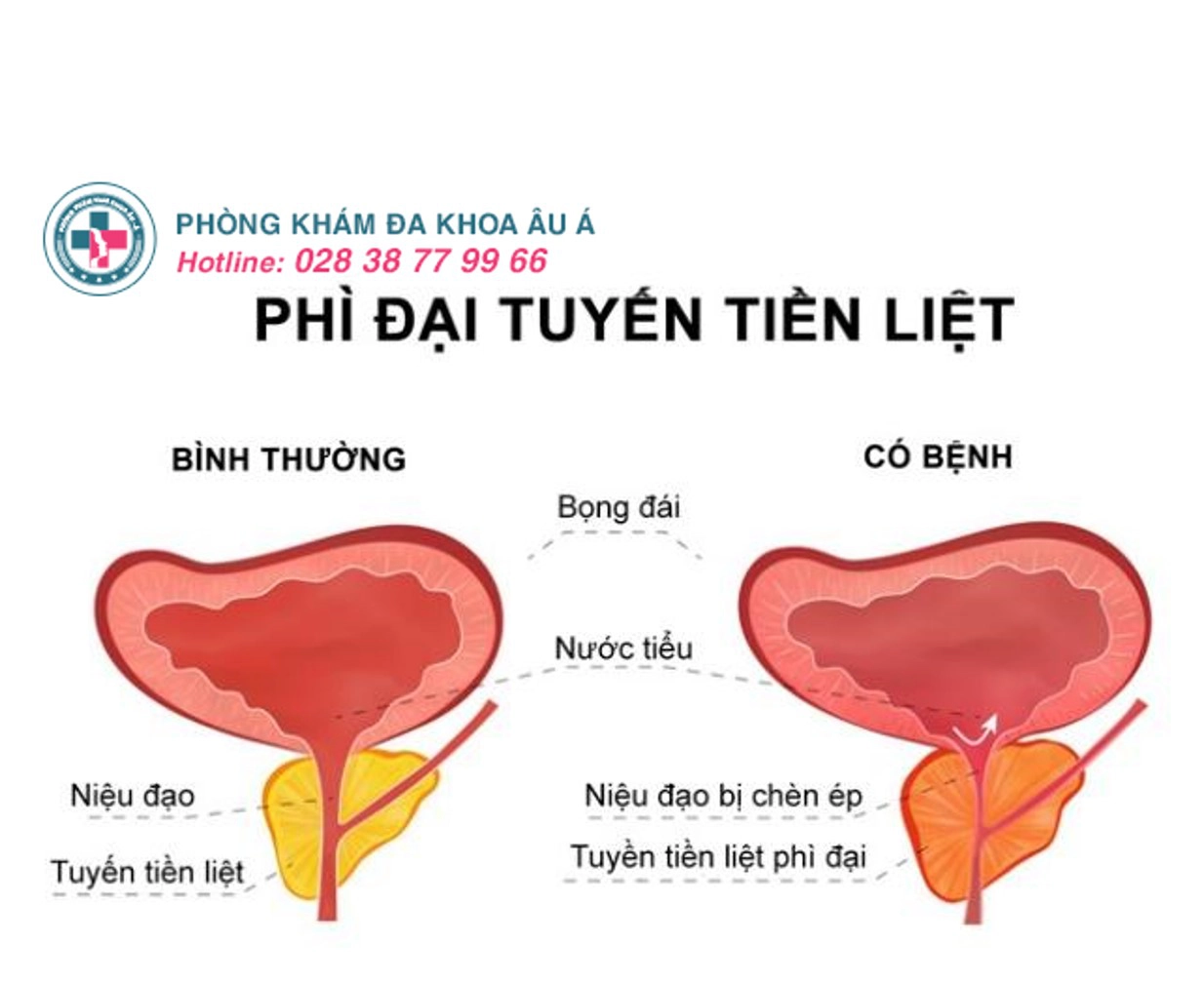 Tiểu ra máu