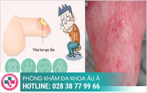 Lở loét bao quy đầu