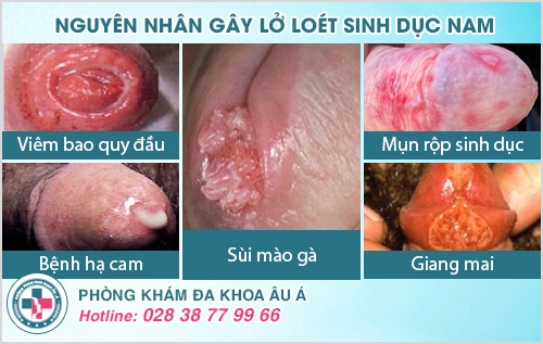 Lở loét bộ phận sinh dục nam