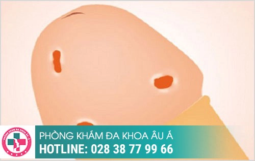 Nấm bao quy đầu