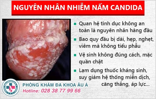 Nhận biết và điều trị nấm Candida nam hiệu quả