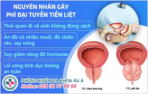 Phì đại tuyến tiền liệt là gì? Nguyên nhân và dấu hiệu nhận biết