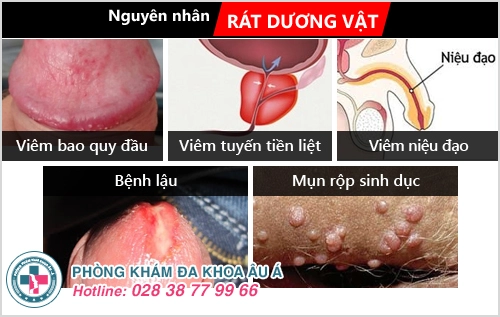 Rát dương vật ở nam giới là dấu hiệu bệnh gì?