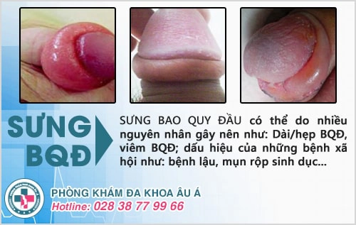 Sưng bao quy đầu là bị bệnh gì? Có nguy hiểm không?
