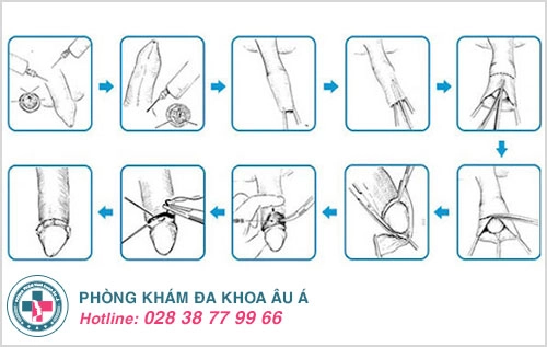 phẫu thuật cắt bao quy đầu
