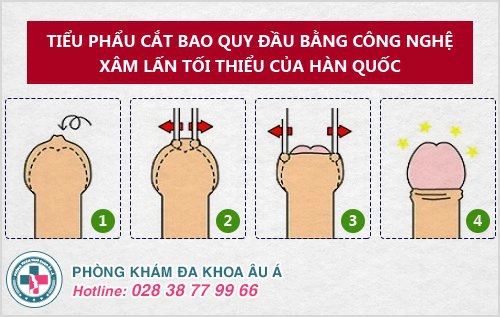 Thế Nào Là Cắt Bao Quy Đầu?