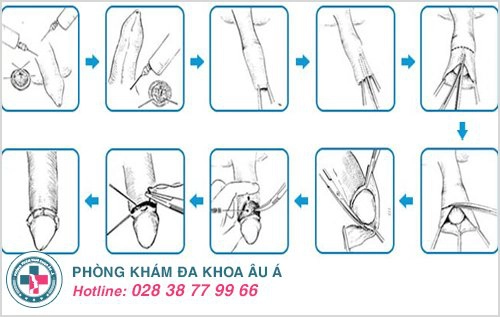 hẹp bao quy đầu