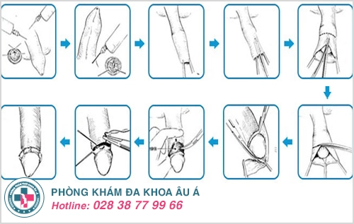 Cách chữa xuất tinh sớm, kéo dài thời gian quan hệ cho nam giới