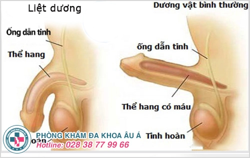 rối loạn cương dương