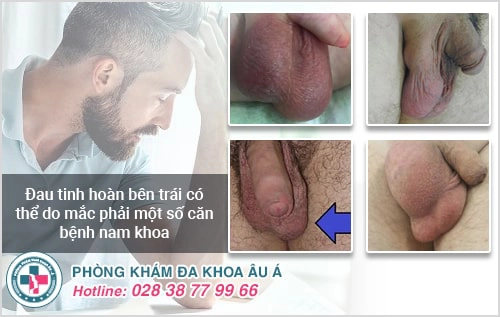 Sưng Tinh Hoàn Bên Trái Và Những Bệnh Lý Liên Quan
