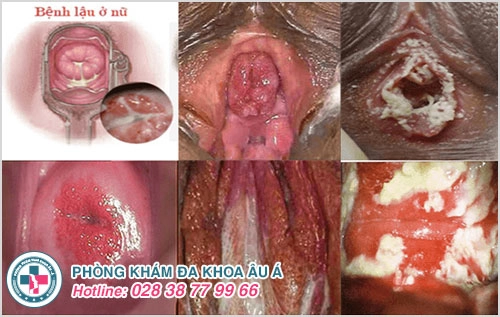 Tiểu ra máu ở phụ nữ là bệnh gì?