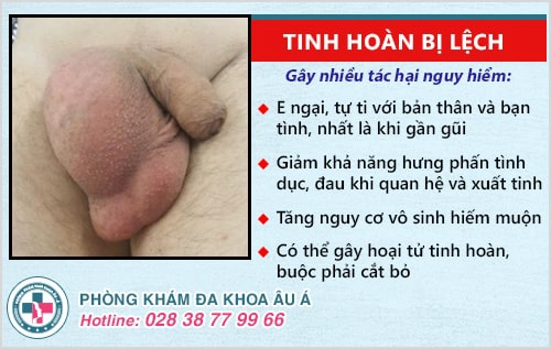 Tinh hoàn bị lệch do đâu? Có sao không?