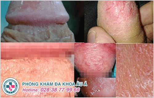 Cứ “quan hệ” xong là bị tróc da dương vật