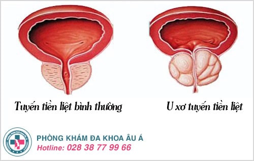 u xơ tuyến tiền liệt