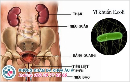 Viêm đường tiết niệu nam