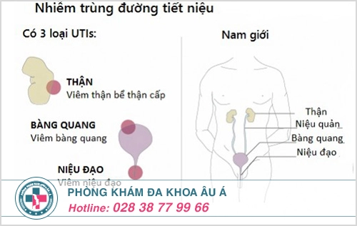 Hình ảnh viêm đường tiết niệu ở nam giới