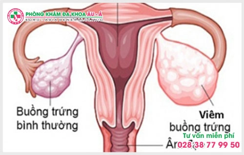bieu-hien-va-trieu-chung-cua-viem-buong-trung