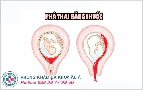 các loại thuốc phá thai