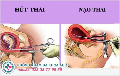 các phương pháp bỏ thai
