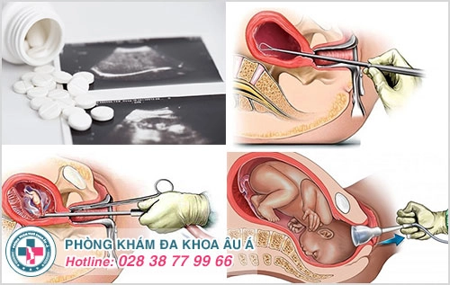 chi phí phá thai phục thuộc vào phương pháp