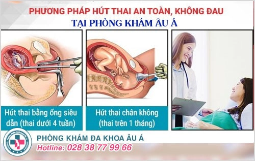 Phương pháp hút thai không đau