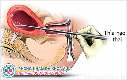 Nạo thai