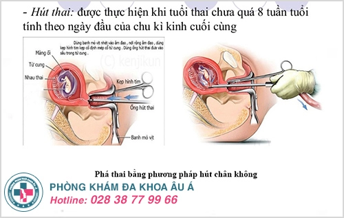 Phương pháp hút thai