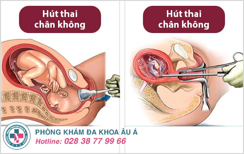 Kỹ thuật hút thai