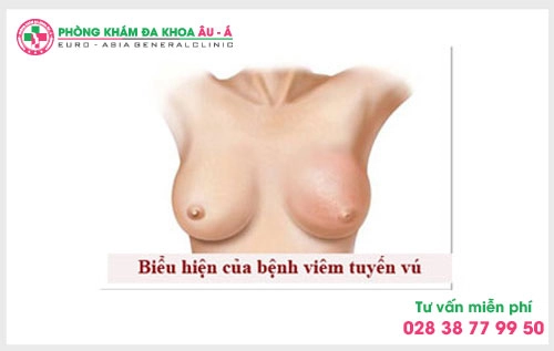 nguyen-nhan-va-tac-hai-cua-benh-viem-tuyen-vu
