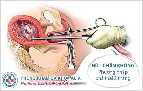 Phương pháp hút chân không