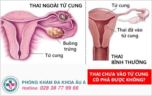 thai chưa vào tử cung có phá được không