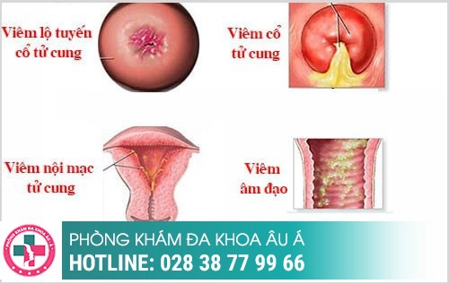 Chậm kinh ra máu nâu