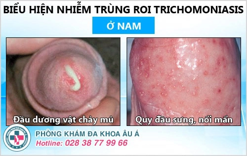 Bị nhiễm trichomonas – đừng nên chủ quan!
