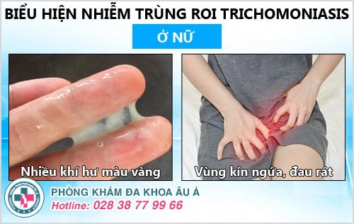 Bị nhiễm trichomonas – đừng nên chủ quan!