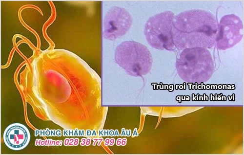 Bị nhiễm trichomonas – đừng nên chủ quan!