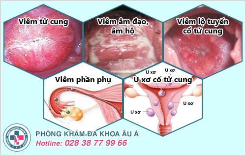 Tổng hợp những bệnh phụ khoa thường gặp ở nữ giới