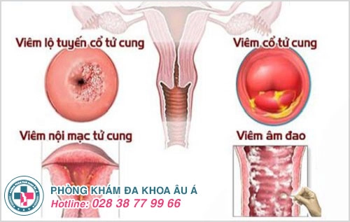 Hột le, mồng đốc, âm vật bị đau là dấu hiệu của bệnh gì?