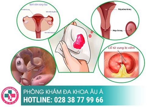 NGUYÊN NHÂN CHẢY MÁU ÂM ĐẠO LÀ GÌ?
