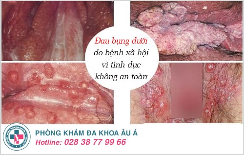 đau bụng dưới