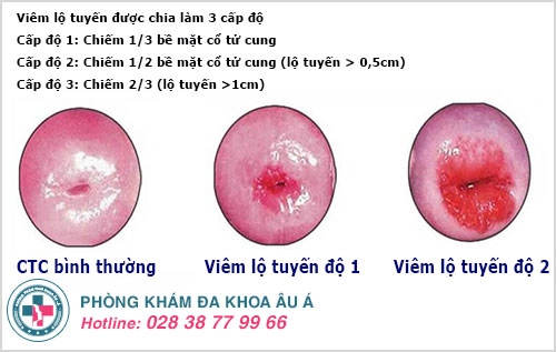 Điều trị viêm lộ tuyến sớm chính là cách bảo vệ thiên chức làm mẹ