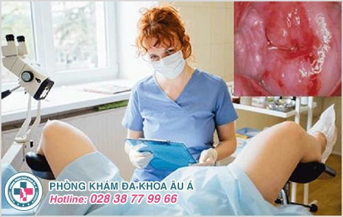 Những thông tin về đốt viêm lộ tuyến cổ tử cung